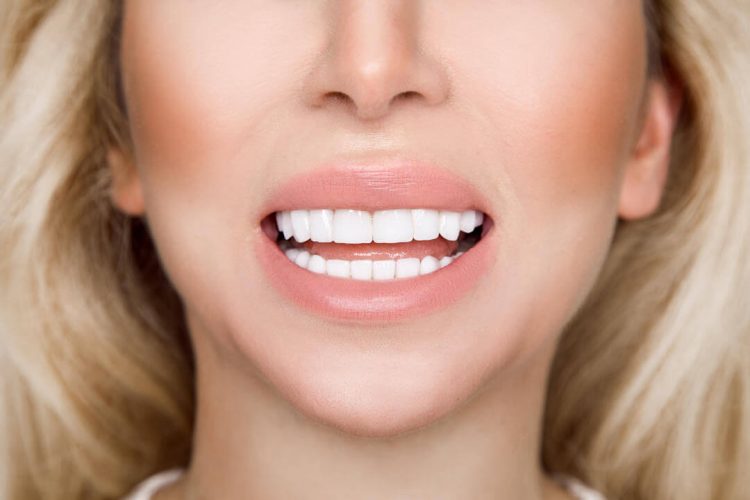 Miami-Porcelain-Veneers