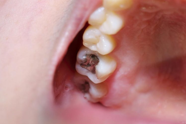 mercury-and-amalgam