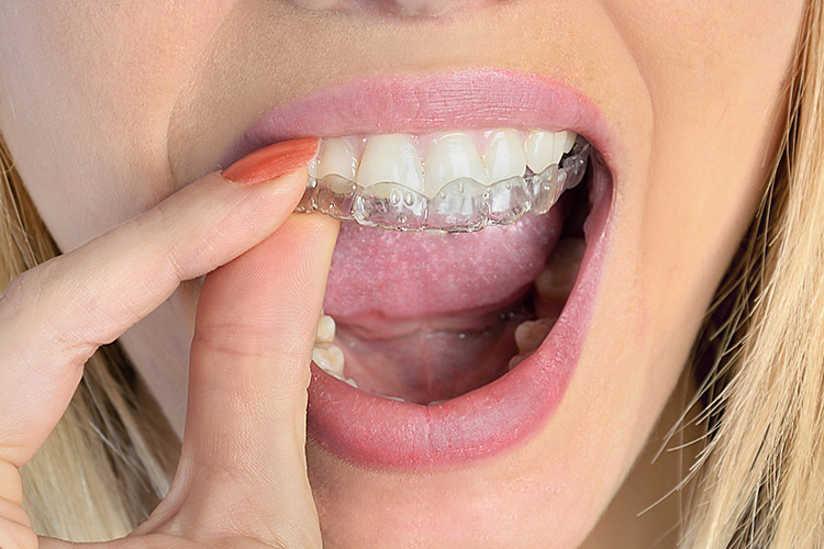 night-guard-sharp-dentistry