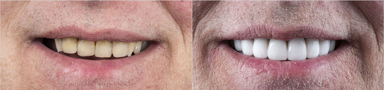 MIAMI VENEERS-BEFORE-AFTER